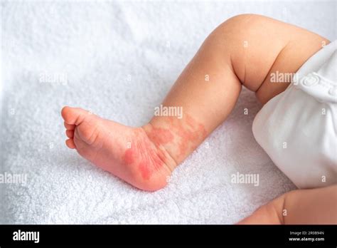 Gutartiges Wachstum Fotos Und Bildmaterial In Hoher Aufl Sung Alamy