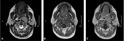 A Axial T Weighted Precontrast Image Shows A Mass Arrows Markedly