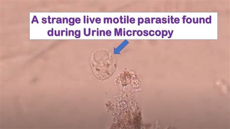 Live Motile Parasite Encountered During Urine Microscopy Youtube