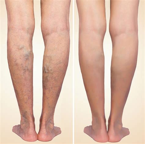 The Minute Rule For Varicose Veins Diagnosis And Treatment