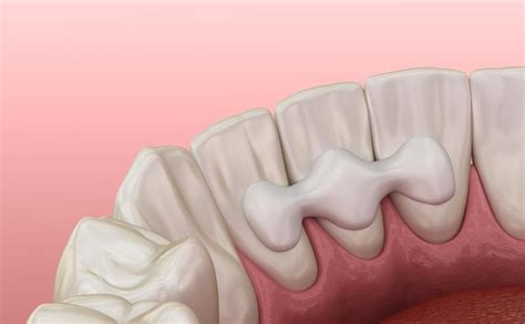 What Is A Maryland Dental Bridge Chagger Dental