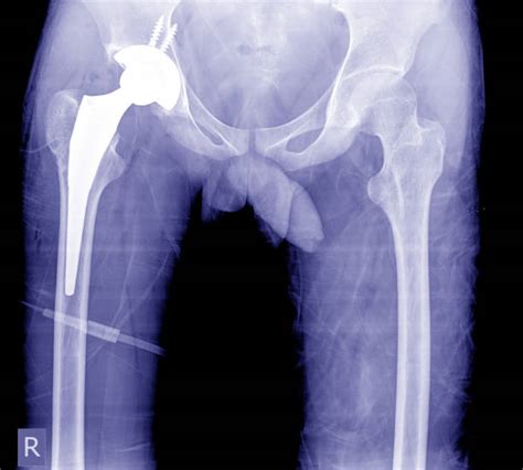 List 105 Pictures Female Hip Replacement Surgery Pictures Sharp