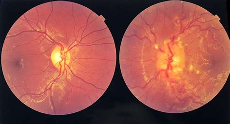 Unilateral papilloedema | Practical Neurology