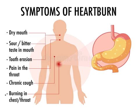 Symptoms Of Heartburn Information Infographic Stock Vector