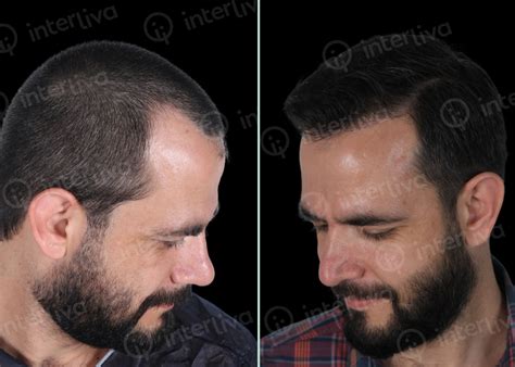 Hair Transplant Before And After Photos Interliva Hair