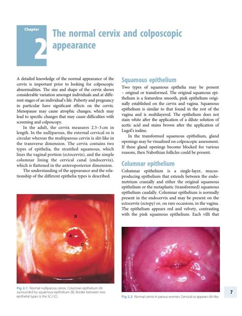 The normal cervix and colposcopic appearance (Chapter 2) - Colposcopy