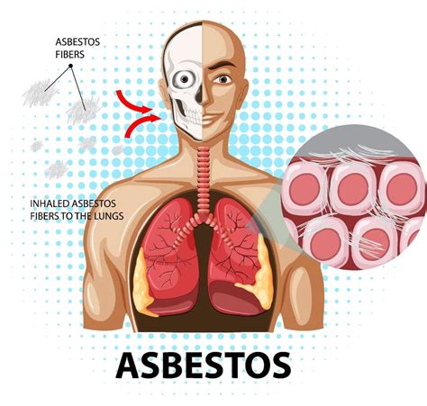 Diagram Showing Asbestosis In Lungs 9202049 Vector Art At Vecteezy