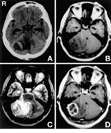 A Computed Tomography Scan Showing Cerebellar Hemorrhage Surrounded By