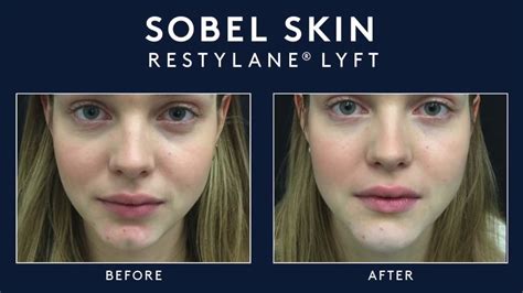 Restylane Lyft Lips Before And After | Lipstutorial.org