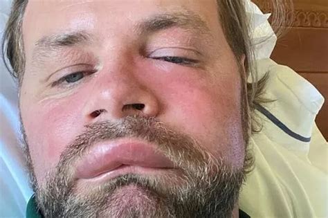 Brian Mcfadden Rushed To Hospital After Bee Sting Leaves Him