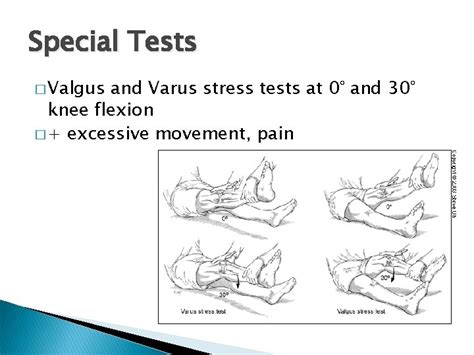 Patellofemoral Pain Syndrome Assessment And Intervention Strategies Donna