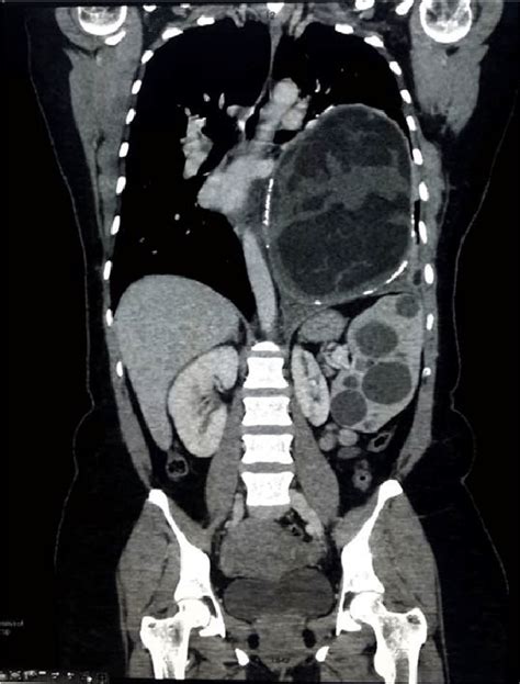 Why Ct Scan Abdomen Pelvis