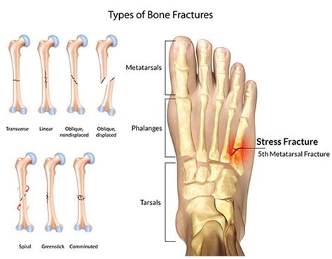 Foot Fracture Treatment Specialist · 2018 Top Foot Doctor, Podiatrist NYC