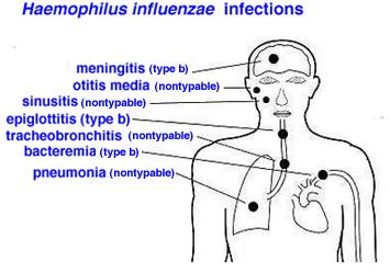 Pathogenesis of Haemophilus influenzae - Overall Science