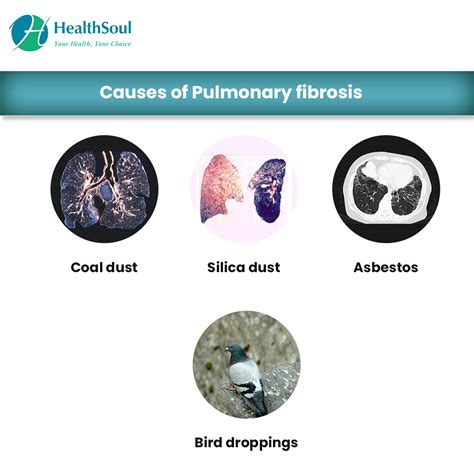 Pulmonary Fibrosis: Causes, Symptoms and Treatment – Healthsoul