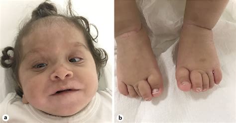 Figure 1 From A Case Of Ring Chromosome 18 With Single Umbilical Artery