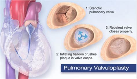 valvular heart disease therapeutics interventions medications