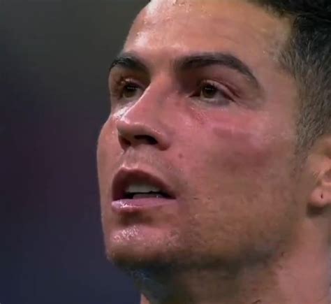 TCR On Twitter Cristiano Ronaldo Bruised Up From Keylor Navas Hit