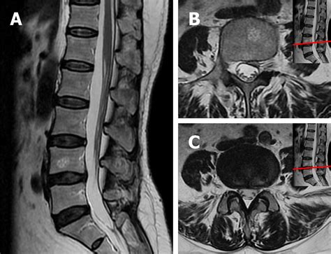 Lumbar Herniated Disc Mri