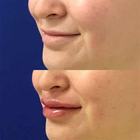 Restylane Kysse Lip Fillers In Santa Rosa And Healdsburg