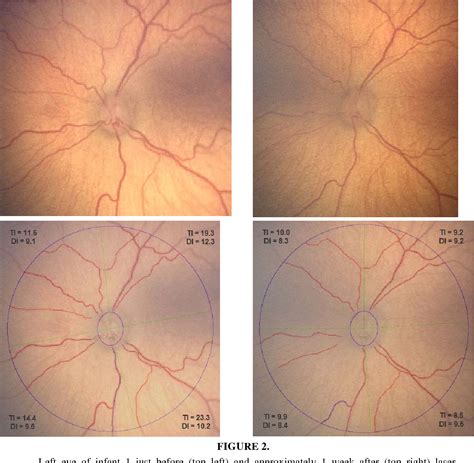 Retinopathy Of Prematurity Plus Disease