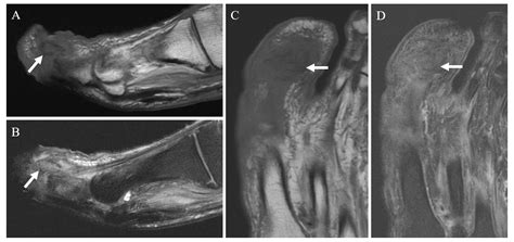 JBJI Outcomes In Patients With Clinically Suspected Pedal