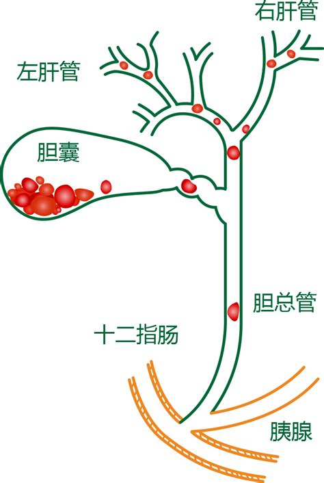 胆总管结石胆总管结石怎么治疗贵阳胆总管结石医院贵阳胆管结石医院贵阳结石病医院