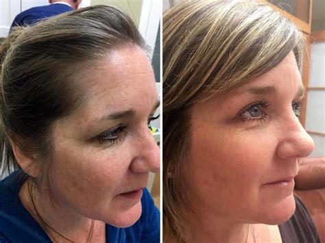 Vampire Facelift Before And After Pics 2 Facelift Info Prices