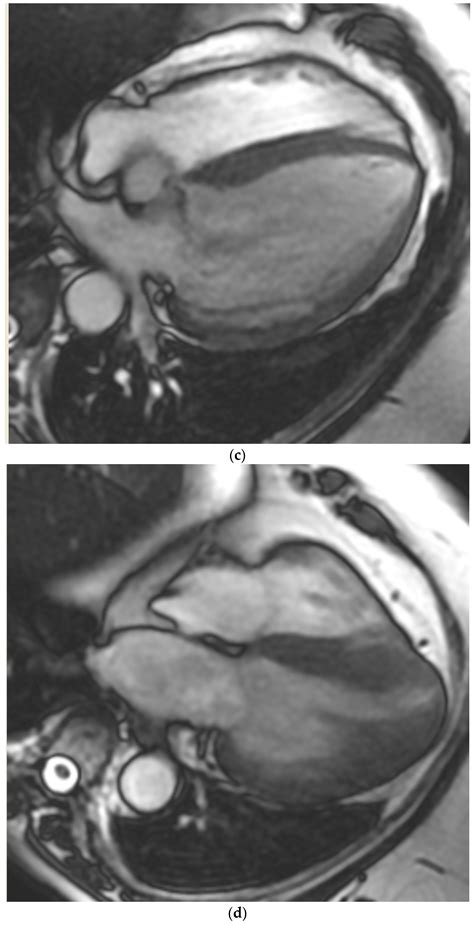 Jcm Free Full Text Echocardiography And Cardiac Magnetic Resonance