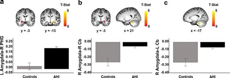 Differences In Rsfc Of The Amygdala In Ahi Versus Controls A Greater