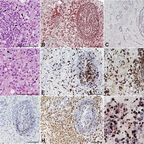 Microscopic Finding Of The Biopsy Specimen From The Erythema An