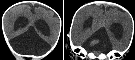 Icd 10 Cm Code For Primary Hydrocephalus