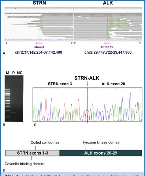 Figure 2 From A Rare Strn Alk Fusion In Lung Adenocarcinoma Identified