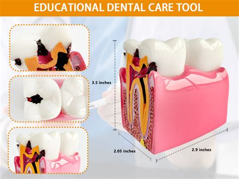 Amazon Dental Caries Teeth Model X X Inches Times