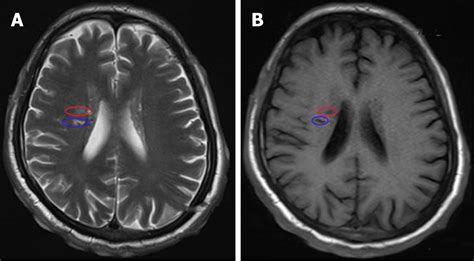 Malignant Syphilis Accompanied With Neurosyphilis In A Malnourished