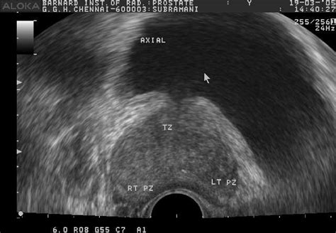 Figure 1 From Role Of Transrectal Sonography With Colour Doppler And