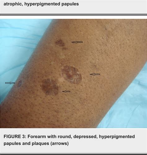 Figure 3 from Recognizing Skin Popping Scars: A Complication of Illicit ...