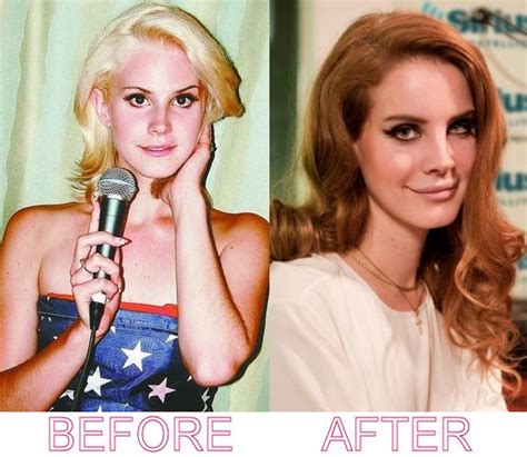 She Was Gorgeous Even Before The Plastic Surgery Plastic Surgery Gone