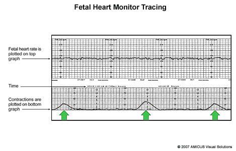 sample of fetal heart monitor tracing and patterns Ob Nursing, Nursing Study, Fetal Heart ...