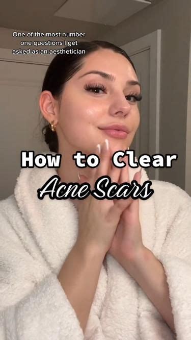 How To Get Rid Of Acne Scars In One Week At Home Artofit