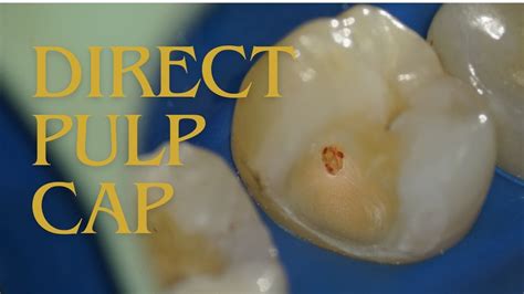 Direct Pulp Cap Procedure Dpc Harvard Bio Cal Cap Youtube