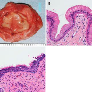 Pathological findings of the cyst. A: Gross anatomy of the excised ...