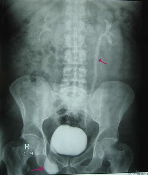 Intravenous Urography Moderate Left Hydronephrosis And Bladder