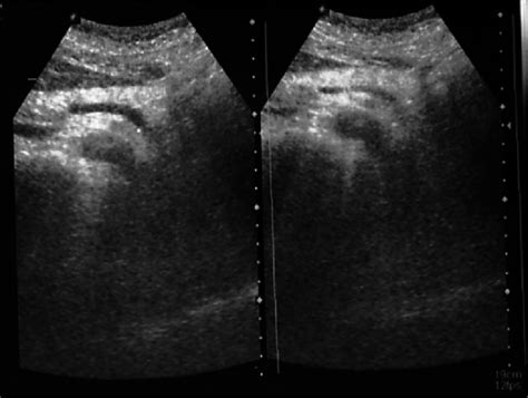 Normal Appearance Of The Pancreas At Ultrasonography Examination Download Scientific Diagram