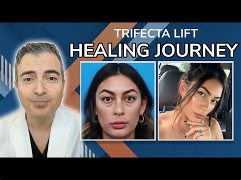 Healing After Trifecta Lift With Dr Kami Parsa Youtube