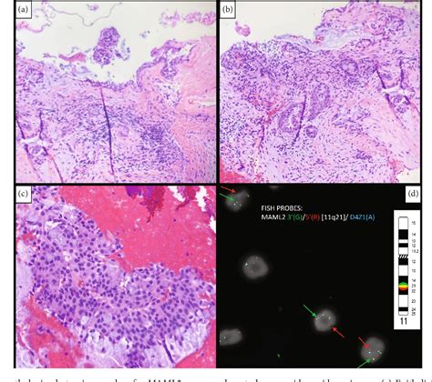 [pdf] Maml2 Rearranged Primary Central Mucoepidermoid Carcinoma Of The Mandible As An Incidental