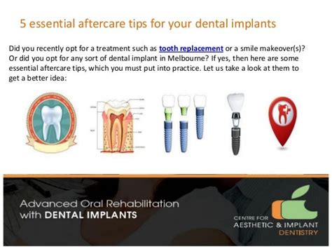 5 Essential Aftercare Tips For Your Dental Implants