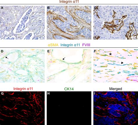 Integrin α11 is expressed in fibroblastlike cells in breast cancer