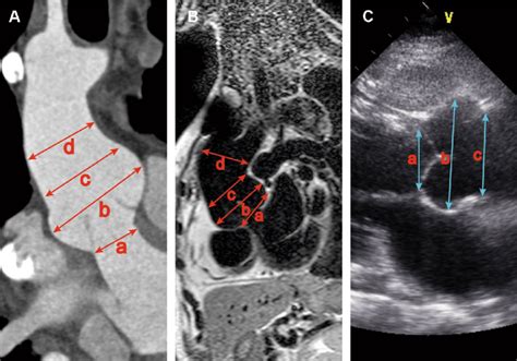 Measurement Of Aortic Components A Cardiac Ct B Cardiac Mri C