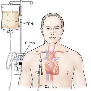 Total Enteral Nutrition